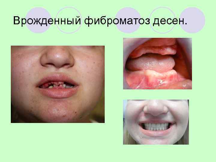 Врожденный фиброматоз десен. 