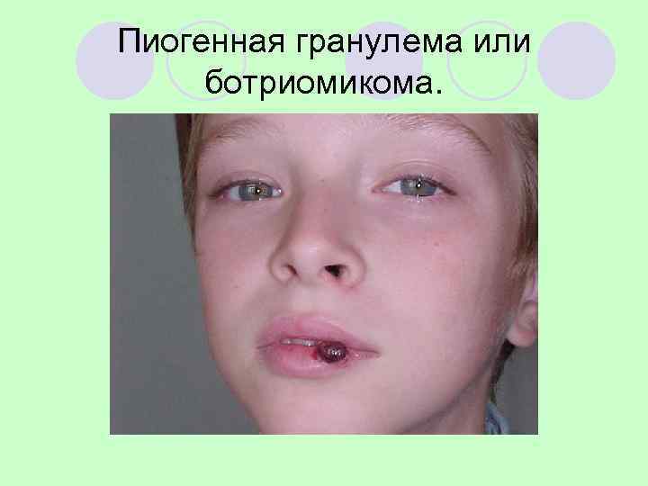 Пиогенная гранулема или ботриомикома. 