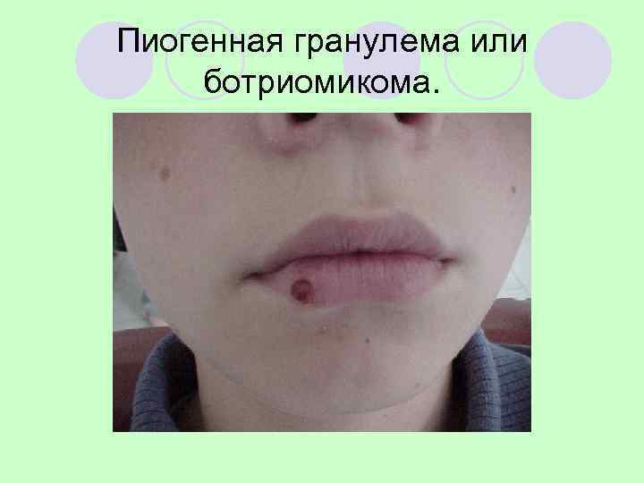 Пиогенная гранулема или ботриомикома. 