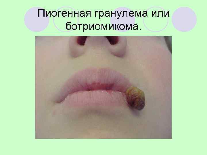 Пиогенная гранулема или ботриомикома. 