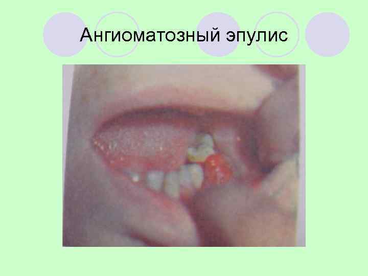 Ангиоматозный эпулис 
