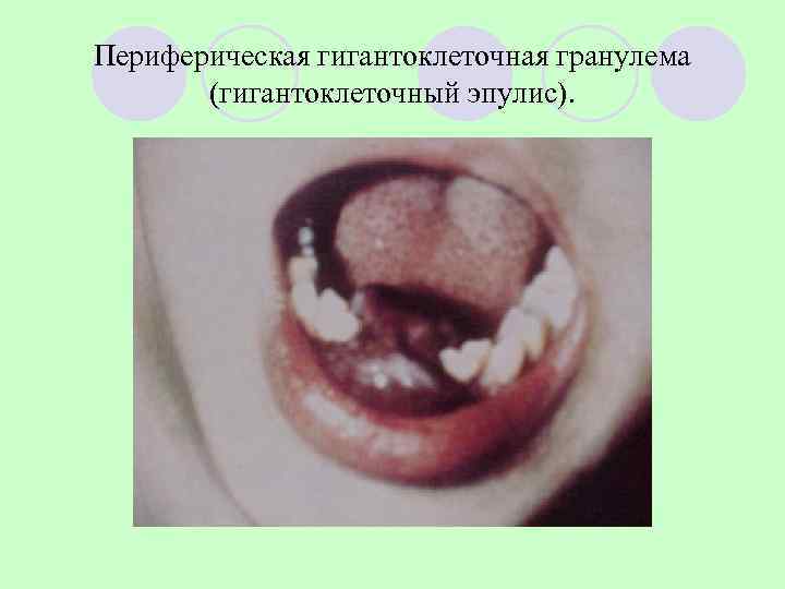 Периферическая гигантоклеточная гранулема  (гигантоклеточный эпулис). 