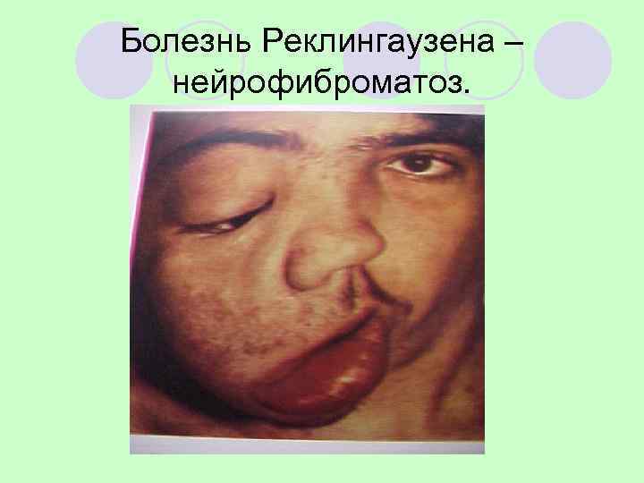 Болезнь Реклингаузена –  нейрофиброматоз. 