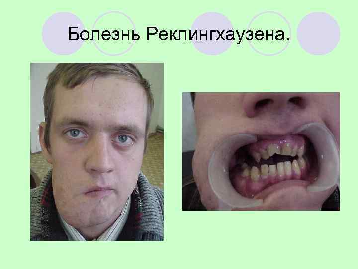Болезнь Реклингхаузена. 