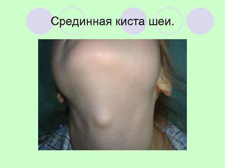 Срединная киста шеи. 