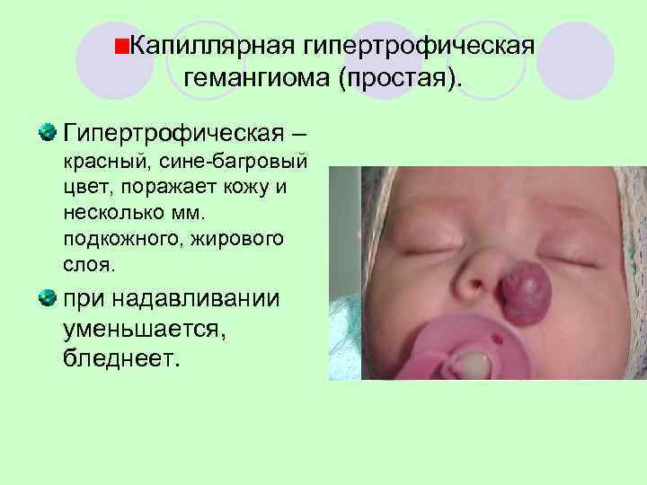  Капиллярная гипертрофическая   гемангиома (простая).  Гипертрофическая – красный, сине-багровый цвет, поражает