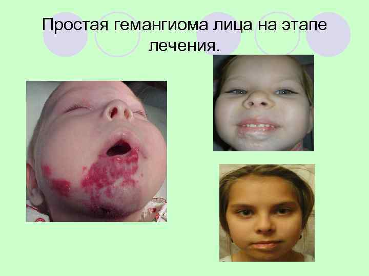 Простая гемангиома лица на этапе   лечения. 