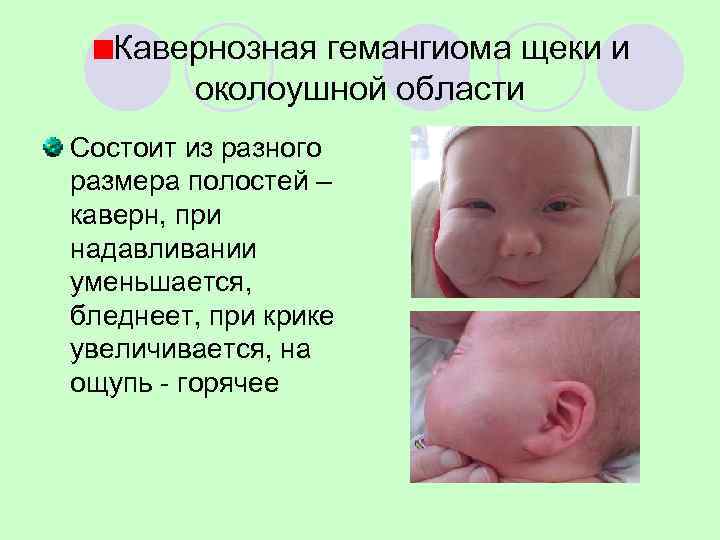   Кавернозная гемангиома щеки и  околоушной области Состоит из разного размера полостей