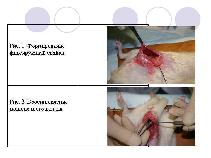 Рис. 1 Формирование фиксирующей спайки Рис. 2 Восстановление мошоночного канала 