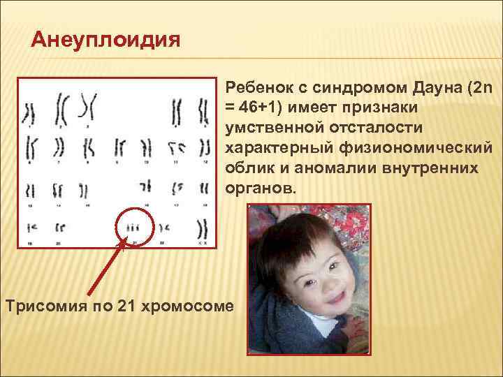 Анеуплоидия Ребенок с синдромом Дауна (2 n Анеуплоидия Ребенок с синдромом Дауна (2 n