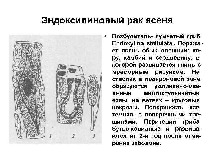 Эндоксилиновый рак ясеня   • Возбудитель- сумчатый гриб   Endoxylina stellulata. Поража
