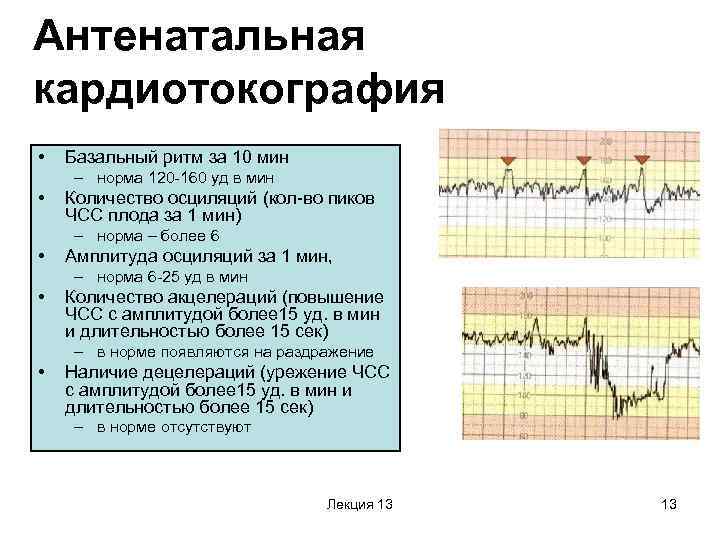 Сердцебиение плода на ктг