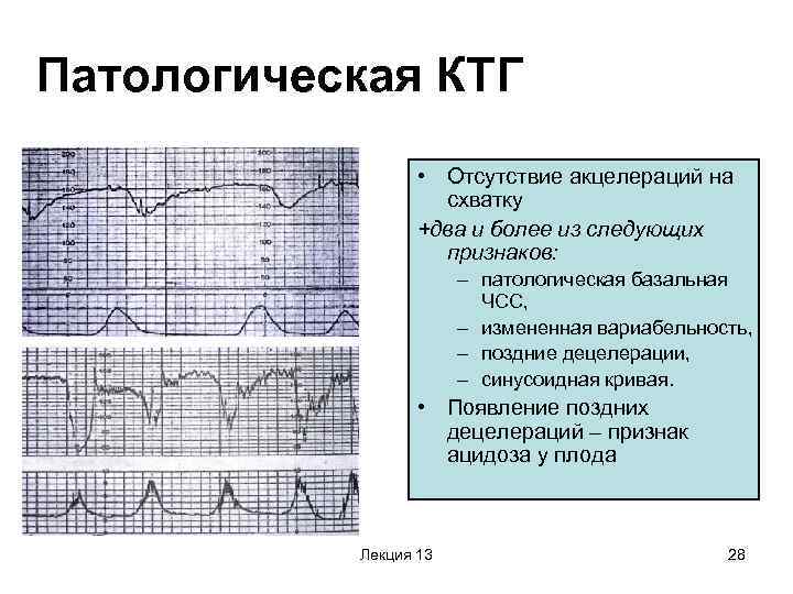 Гипоксия на ктг фото