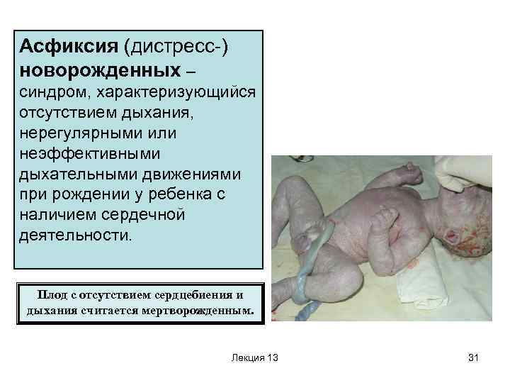Асфиксия (дистресс-) новорожденных – синдром, характеризующийся отсутствием дыхания, нерегулярными или неэффективными дыхательными движениями при