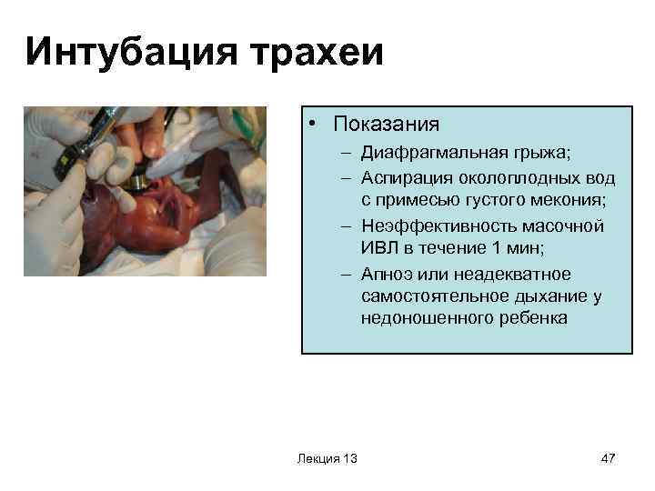 Интубация трахеи    • Показания    – Диафрагмальная грыжа; 