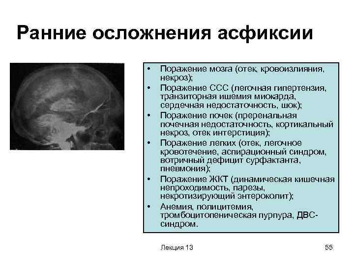 Гипоксия головного мозга