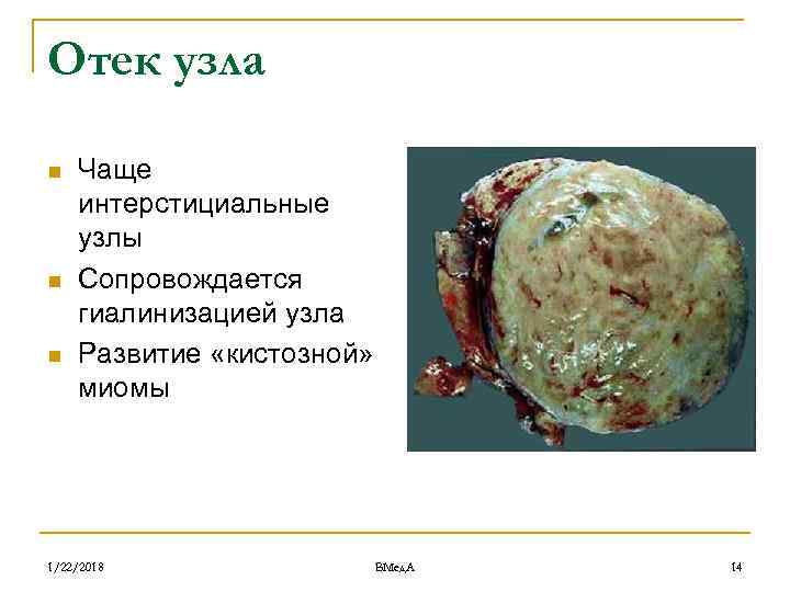 Отек узла n  Чаще интерстициальные узлы n  Сопровождается гиалинизацией узла n 