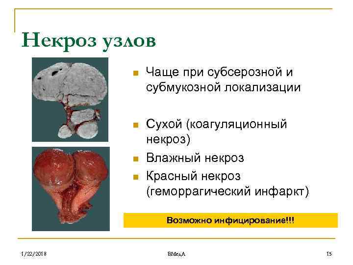 Миома матки презентация гинекология