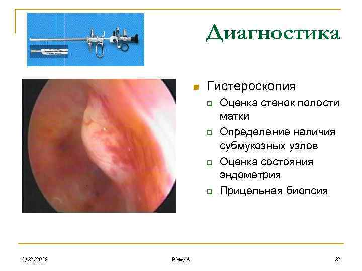     Диагностика     n  Гистероскопия  