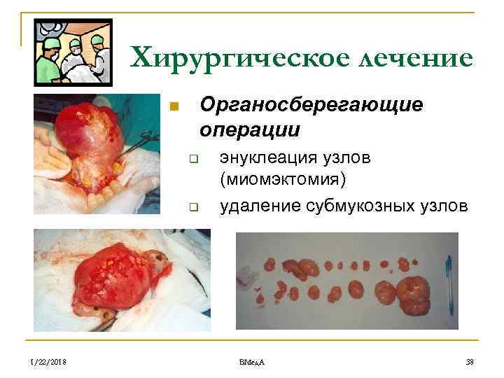   Хирургическое лечение    n  Органосберегающие    операции
