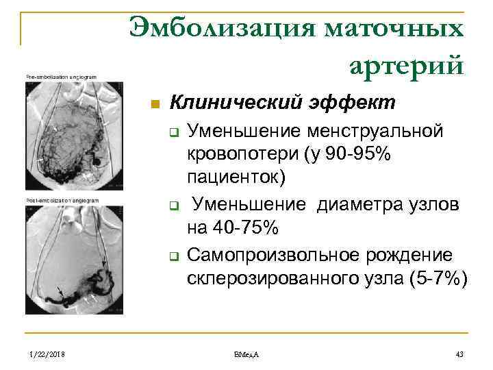   Эмболизация маточных     артерий   n  Клинический
