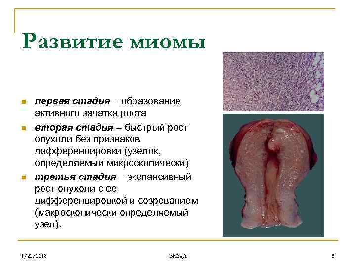 Субсерозная миома матки фото