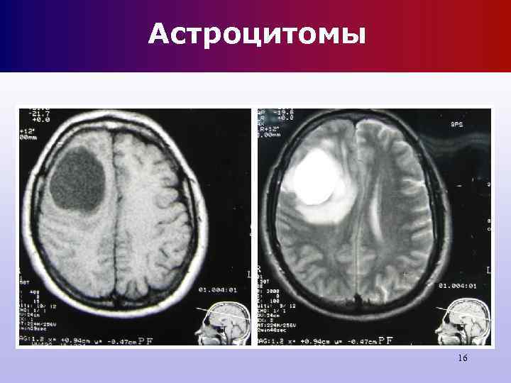 Астроцитомы 16 Астроцитомы 16
