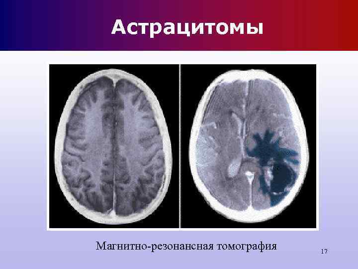 Астрацитомы Магнитно-резонансная томография 17 Астрацитомы Магнитно-резонансная томография 17