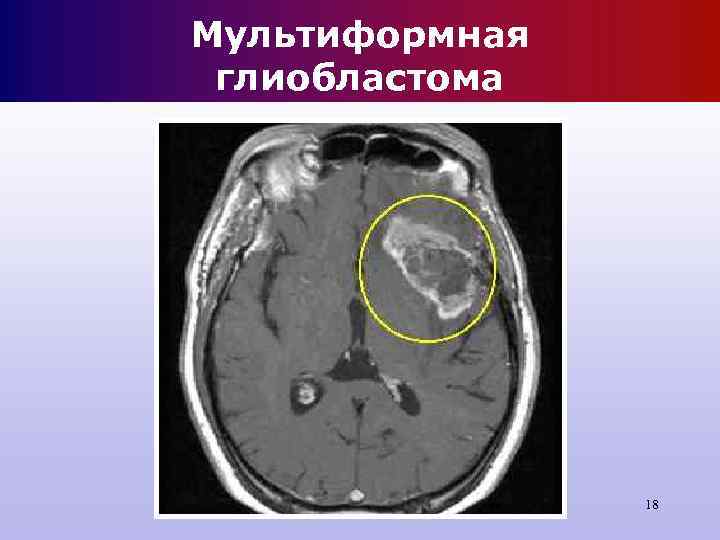 Мультиформная глиобластома 18 Мультиформная глиобластома 18