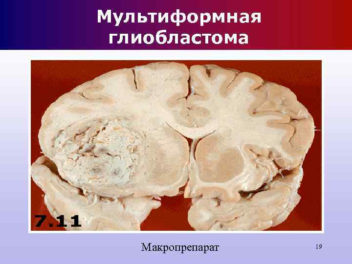 Мультиформная глиобластома Макропрепарат 19 Мультиформная глиобластома Макропрепарат 19