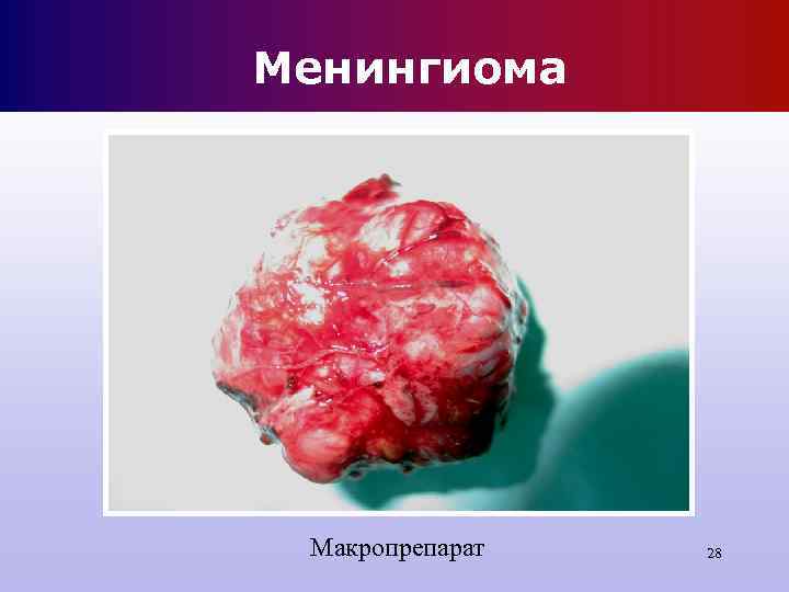 Менингиома Макропрепарат 28 Менингиома Макропрепарат 28