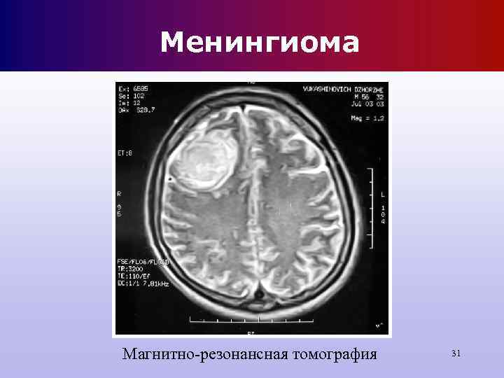 Менингиома Магнитно-резонансная томография 31 Менингиома Магнитно-резонансная томография 31