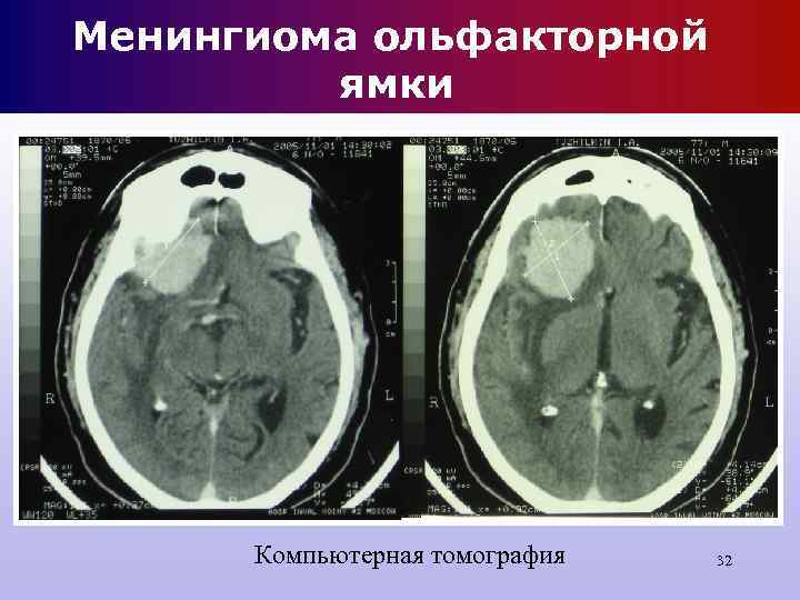 Менингиома ольфакторной ямки Компьютерная томография 32 Менингиома ольфакторной ямки Компьютерная томография 32