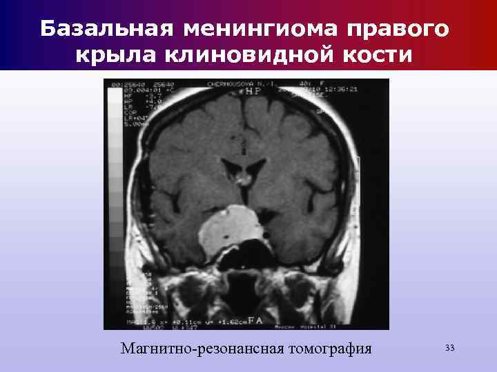 Базальная менингиома правого крыла клиновидной кости Магнитно-резонансная томография 33 Базальная менингиома правого крыла клиновидной кости Магнитно-резонансная томография 33