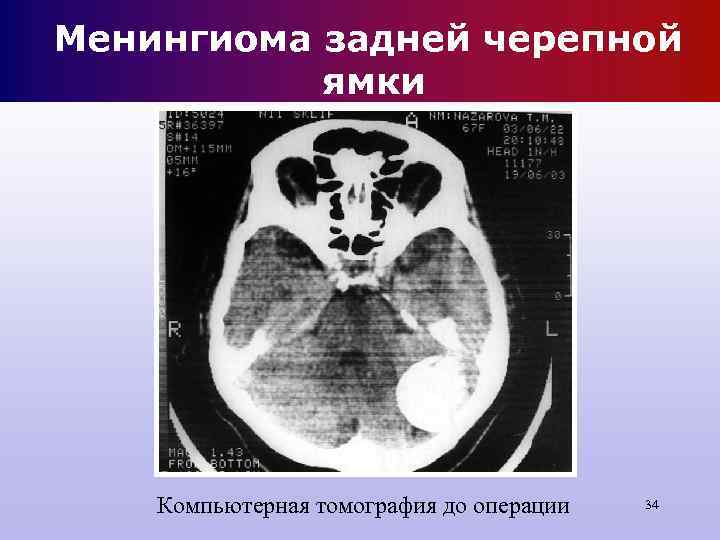 Менингиома задней черепной ямки Компьютерная томография до операции 34 Менингиома задней черепной ямки Компьютерная томография до операции 34