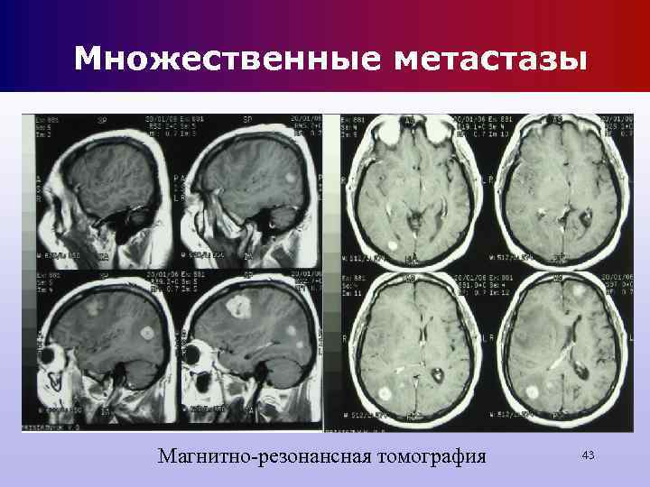 Множественные метастазы Магнитно-резонансная томография 43 Множественные метастазы Магнитно-резонансная томография 43