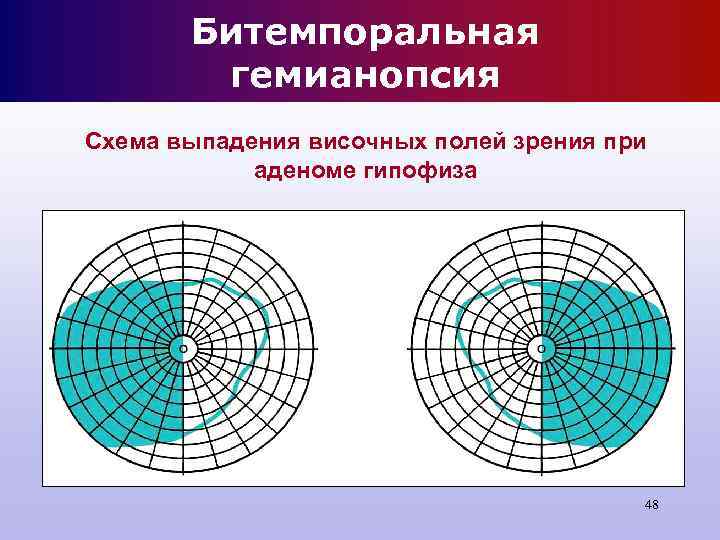 Битемпоральная гемианопсия Схема выпадения височных полей зрения при Битемпоральная гемианопсия Схема выпадения височных полей зрения при