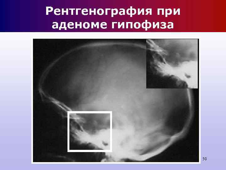Рентгенография при аденоме гипофиза 50 Рентгенография при аденоме гипофиза 50