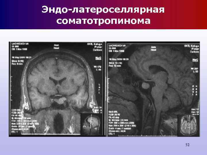 Эндо-латероселлярная соматотропинома 52 Эндо-латероселлярная соматотропинома 52