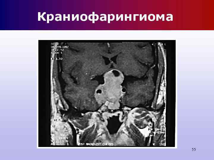 Краниофарингиома 55 Краниофарингиома 55