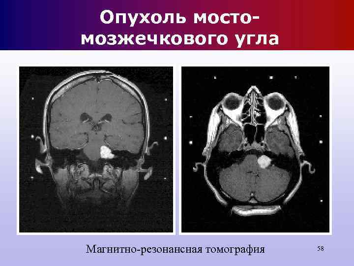 Опухоль мосто- мозжечкового угла Магнитно-резонансная томография 58 Опухоль мосто- мозжечкового угла Магнитно-резонансная томография 58