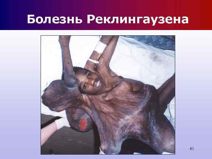 Болезнь Реклингаузена 61 Болезнь Реклингаузена 61