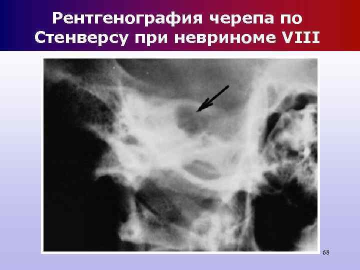 Рентгенография черепа по Стенверсу при невриноме VIII 68 Рентгенография черепа по Стенверсу при невриноме VIII 68