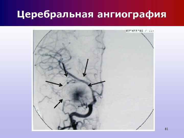 Церебральная ангиография 81 Церебральная ангиография 81