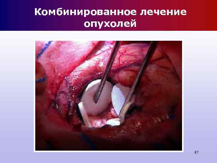 Комбинированное лечение опухолей 87 Комбинированное лечение опухолей 87