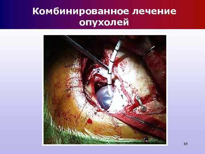Комбинированное лечение опухолей 89 Комбинированное лечение опухолей 89