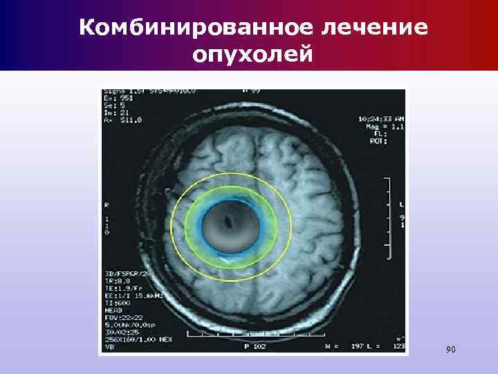 Комбинированное лечение опухолей 90 Комбинированное лечение опухолей 90