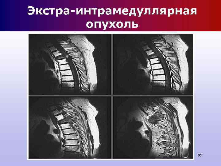 Экстра-интрамедуллярная опухоль 95 Экстра-интрамедуллярная опухоль 95