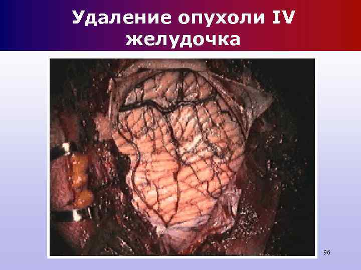Удаление опухоли IV желудочка 96 Удаление опухоли IV желудочка 96