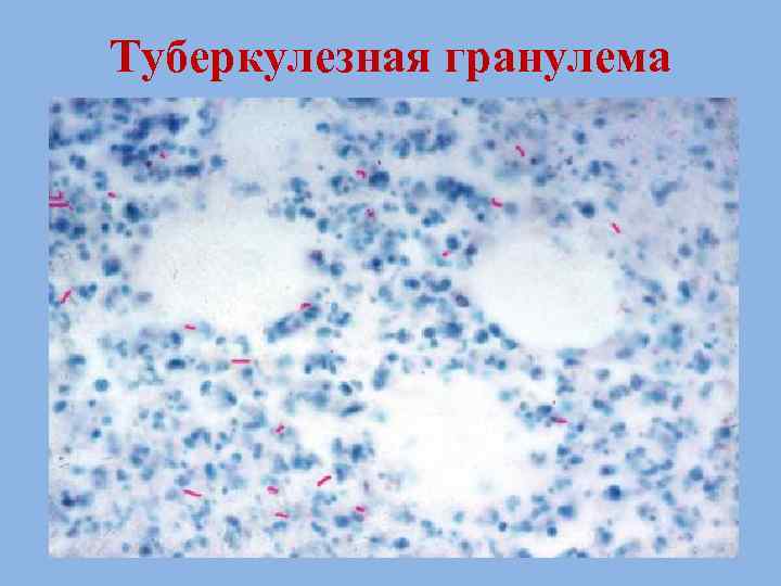 Туберкулезная гранулема рисунок